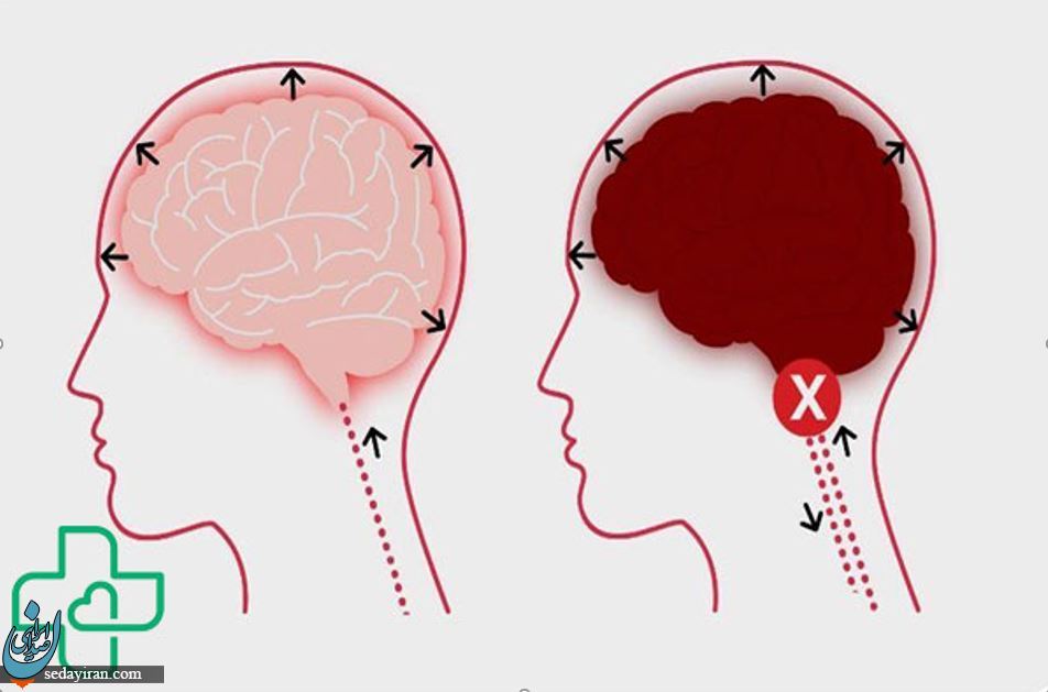 مرگ مغزی چیست و روند درمانی بعد از آن به چه صورت است؟