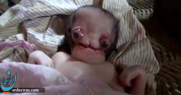 تولد ترسناک ترین نوزاد جهان/ عجیب اما واقعی!