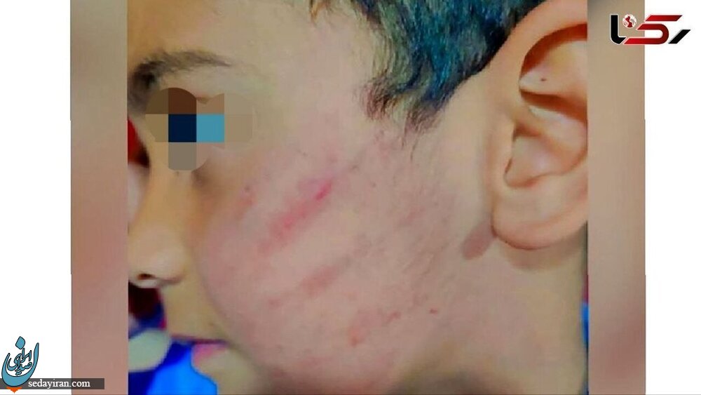 ماجرای کتک خوردن بچه مدرسه ای دبستانی از معلمش در زاهدان + عکس