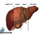 تشخیص بیماریهای کبدی در مراحل ابتدایی تشخیص بیماریهای کبدی در مراحل ابتدایی