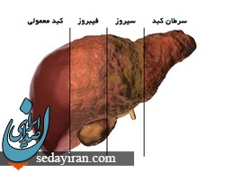 تشخیص بیماری‌های کبدی در مراحل ابتدایی