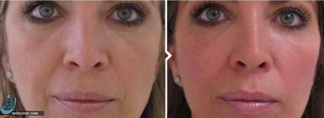 مقایسه استفاده از تزریق ژل و چربی در اصلاح فرم صورت