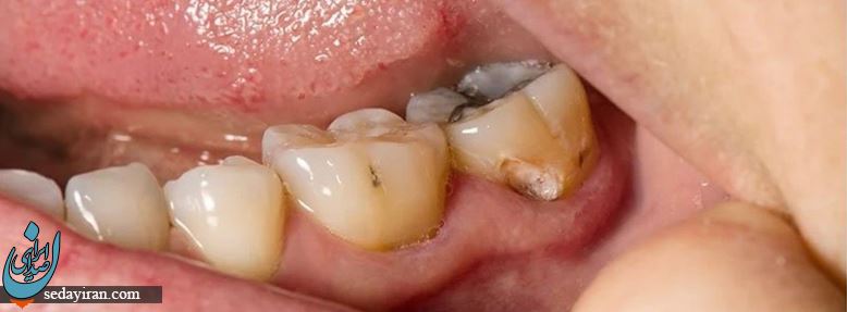 عوارض ایمپلنت دندان: آیا ایمپلنت دندان درد دارد؟