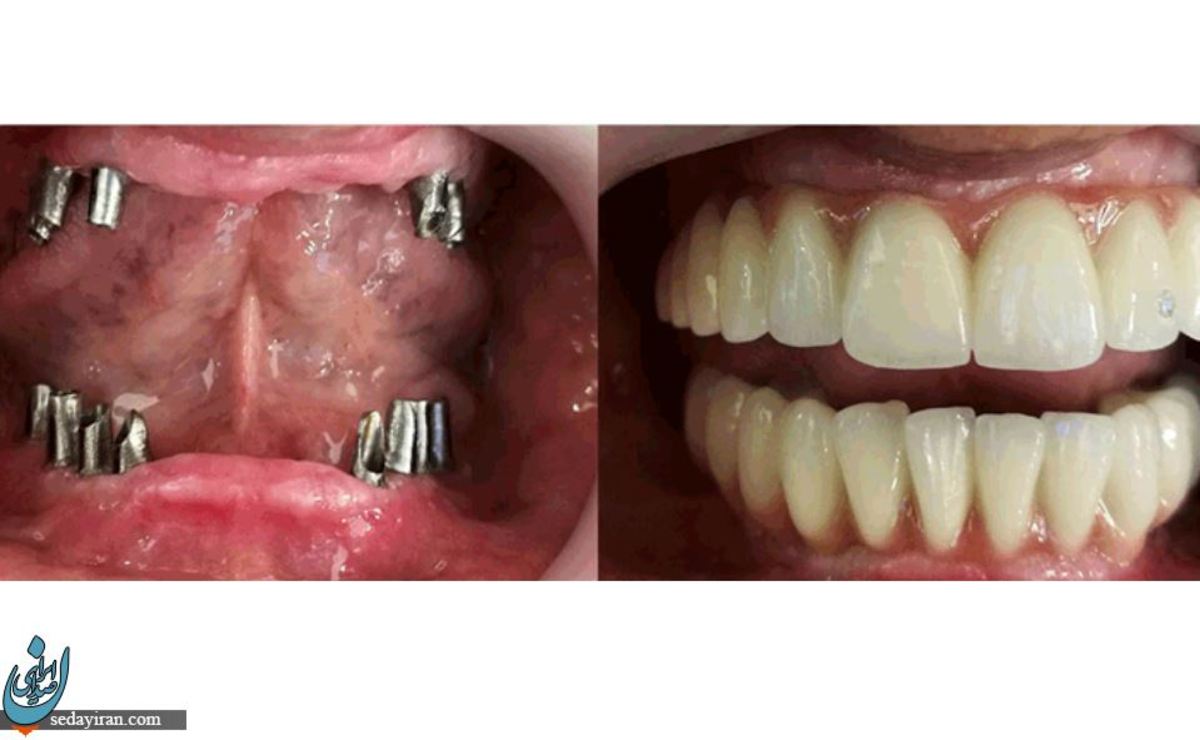همه چیز درباره ایمپلنت فوری دندان   کاشت فوری دندان دائمی