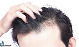 این 6 مشکل چه تاثیری در ظاهر موی سر دارند؟