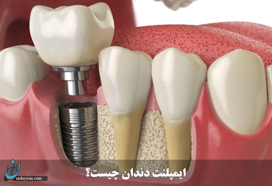 ایمپلنت دندان ایمپلنت دندان
