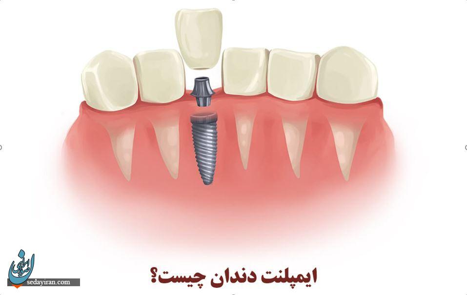 ایمپلنت دندان