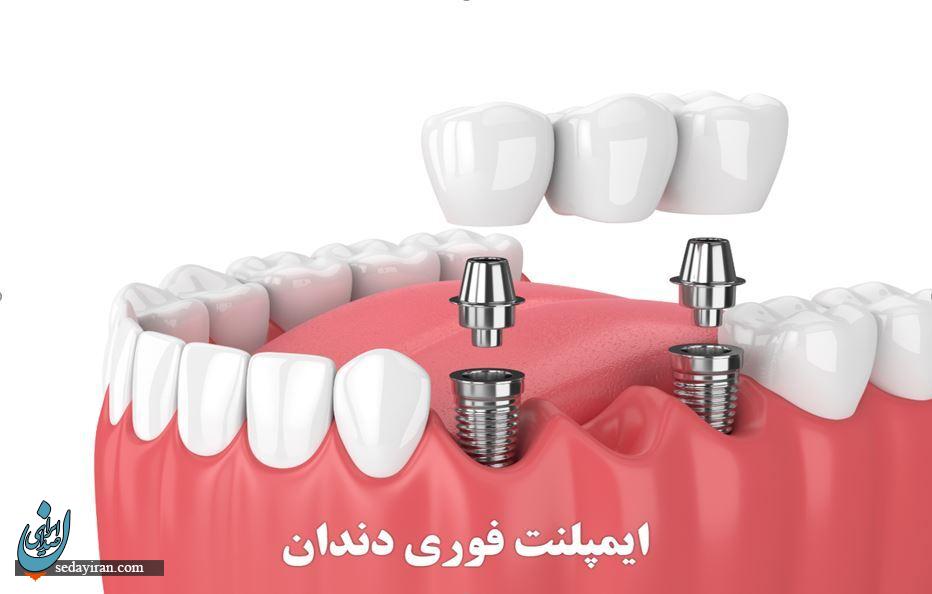 ایمپلنت فوری دندان ایمپلنت فوری دندان