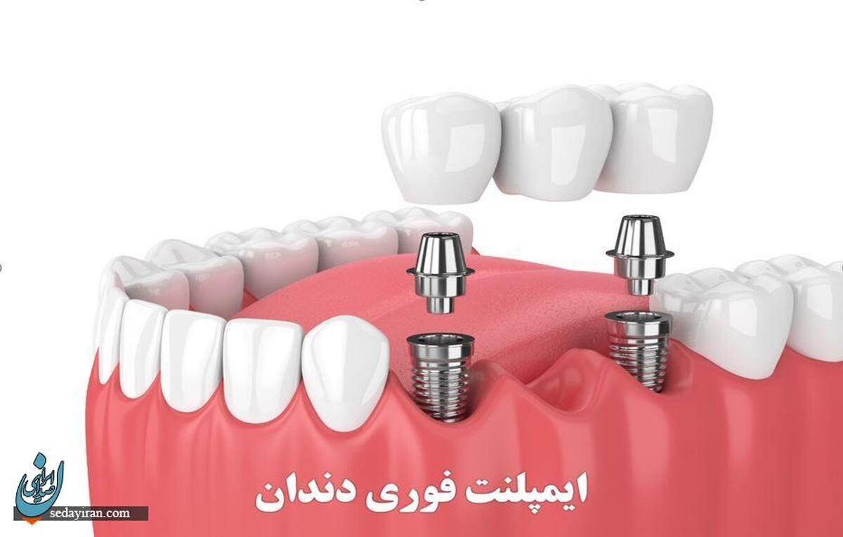 ایمپلنت فوری دندان