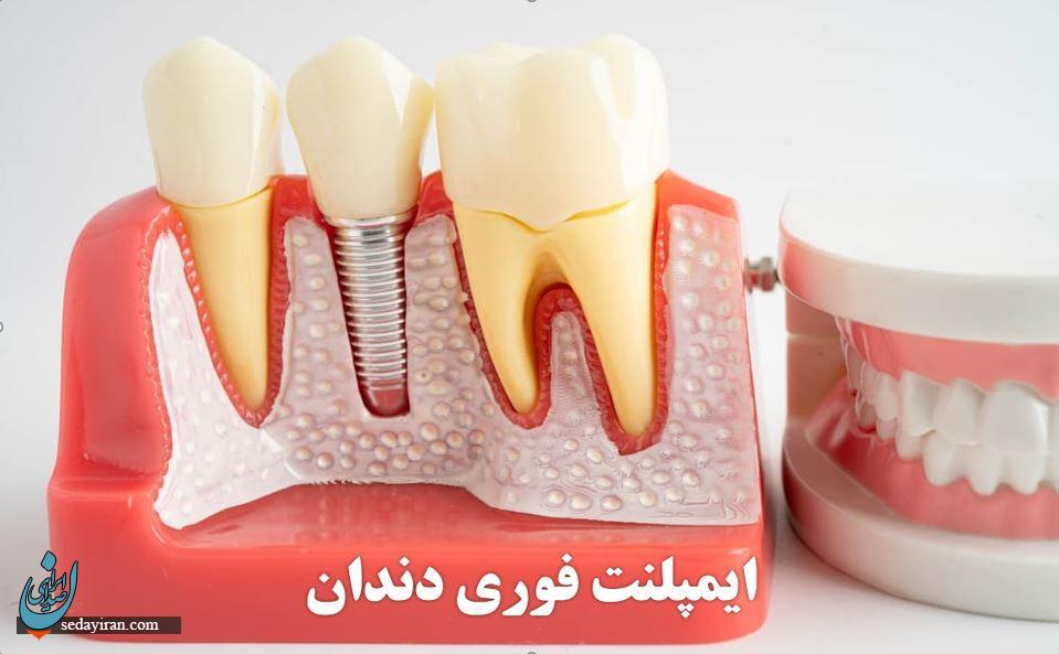 ایمپلنت فوری دندان