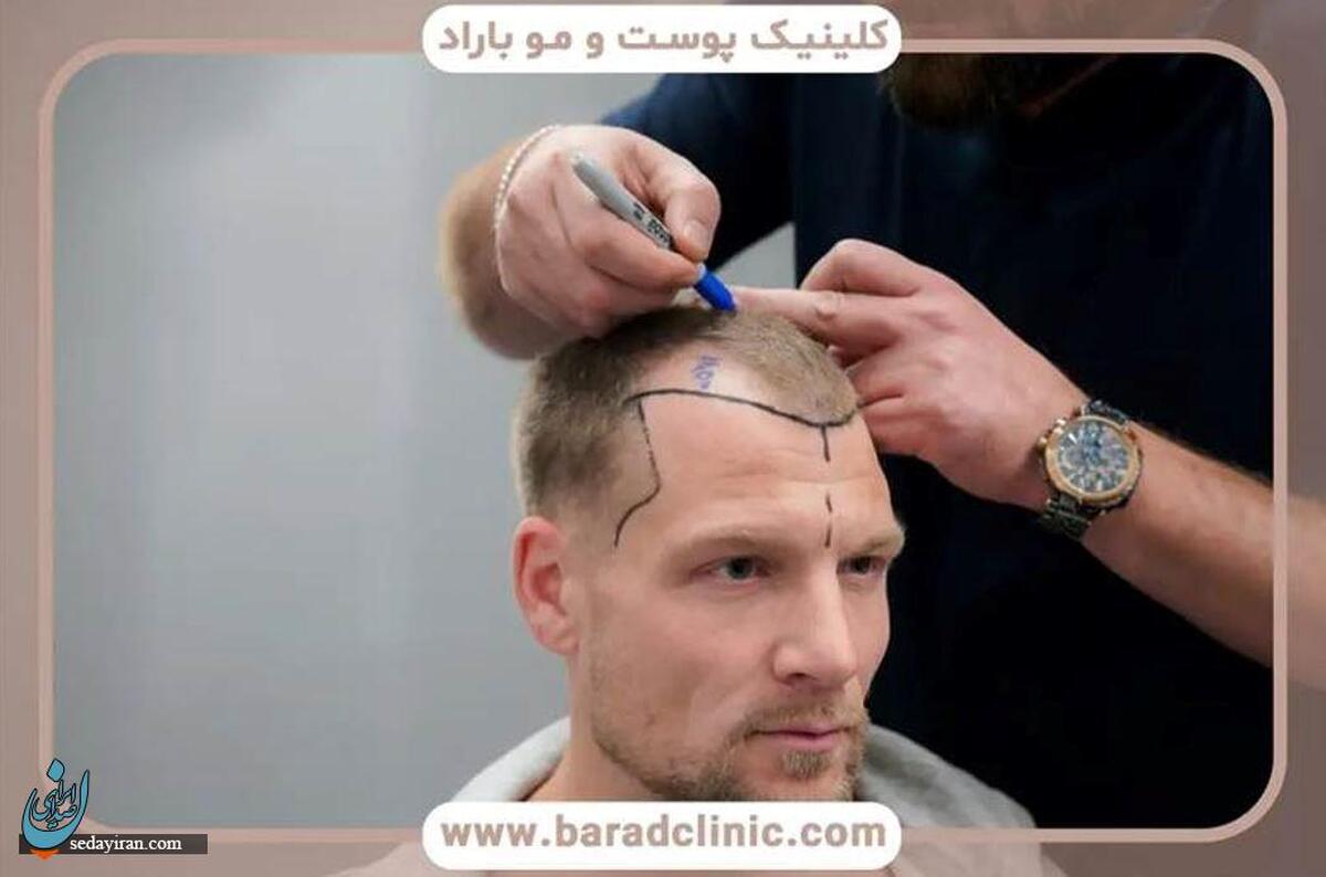 هزینه کاشت مو: همه چیز درباره عوامل تاثیرگذار و نحوه کاهش هزینه‌ها