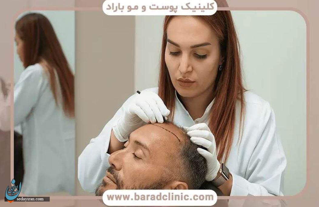 هزینه کاشت مو: همه چیز درباره عوامل تاثیرگذار و نحوه کاهش هزینه‌ها
